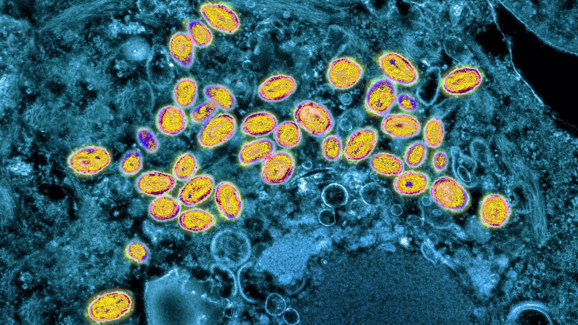 Ancient DNA reveals smallpox's American origin story